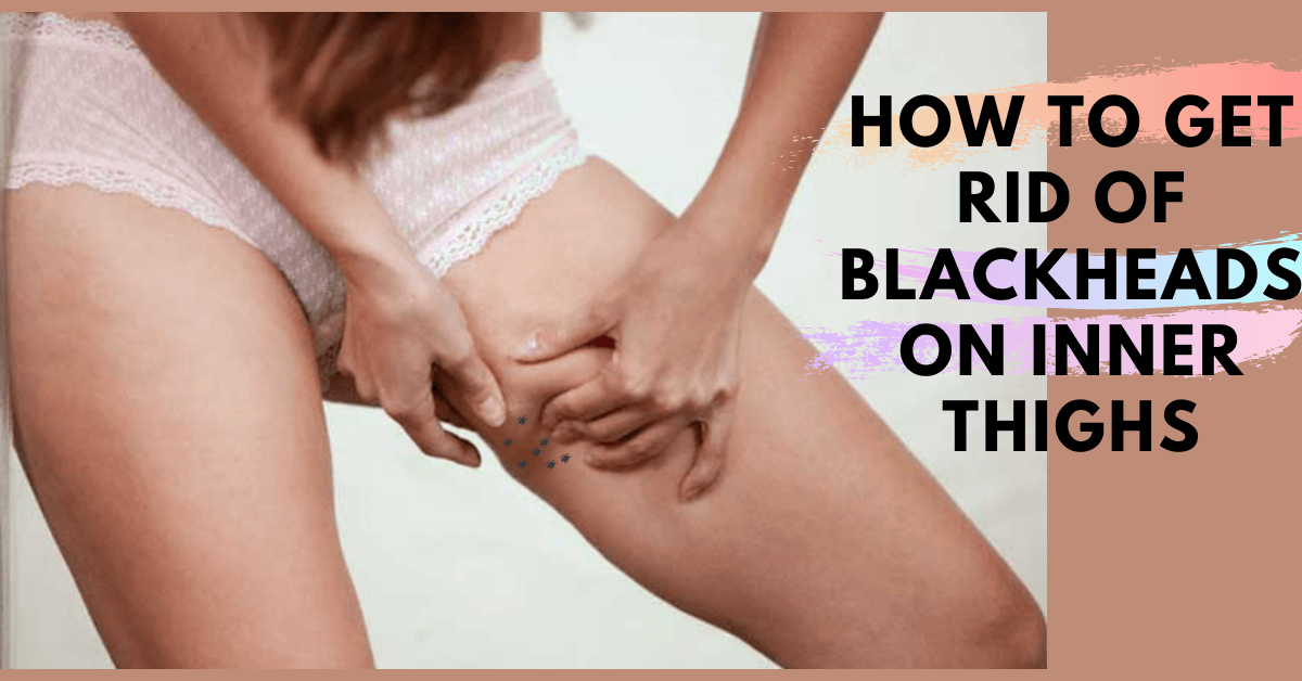 how to get rid of blackheads on inner thighs