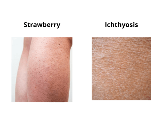 Strawberry & Ichthyosis skin