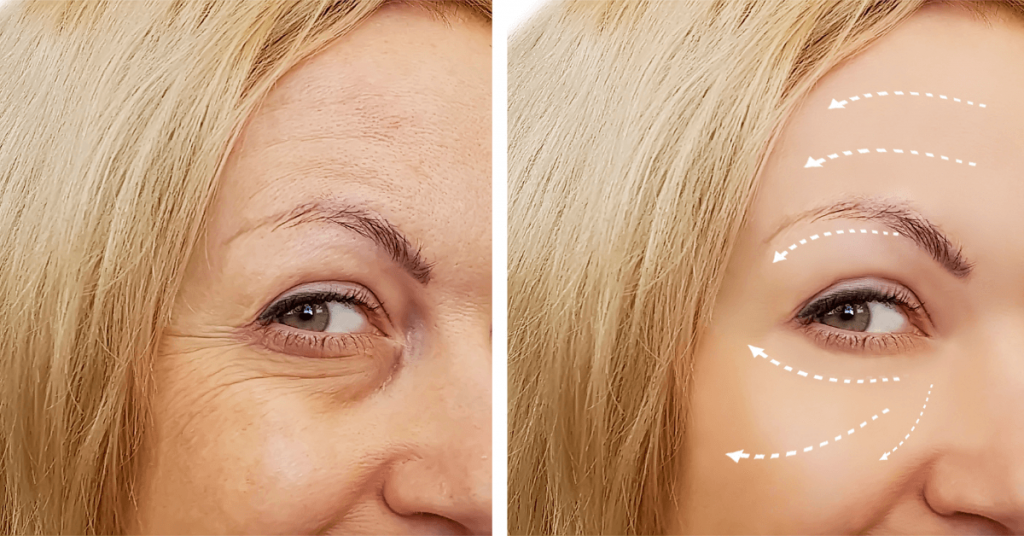 Best Procedure For Under Eye Wrinkles STEPUPTOGRACE