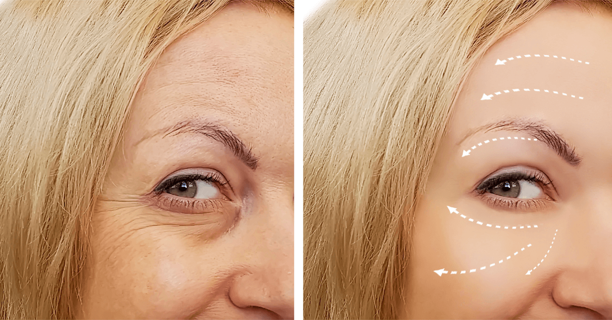 Best Procedure For Under Eye Wrinkles