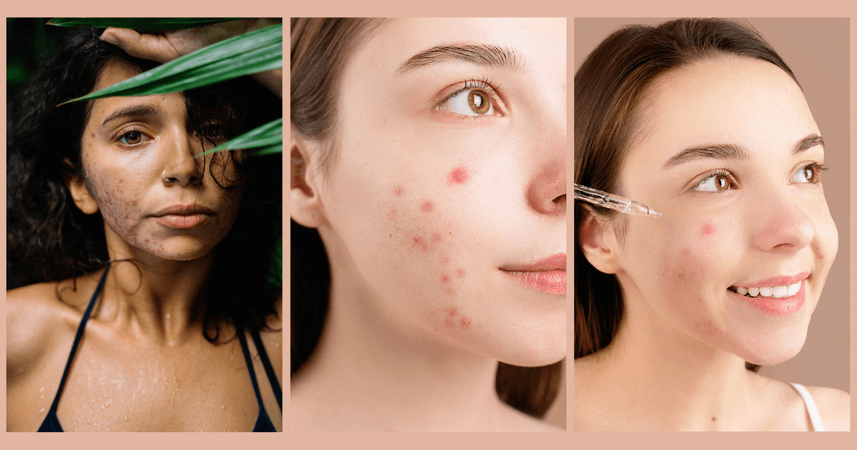 12 Home remedies for acne scars - Rabid result